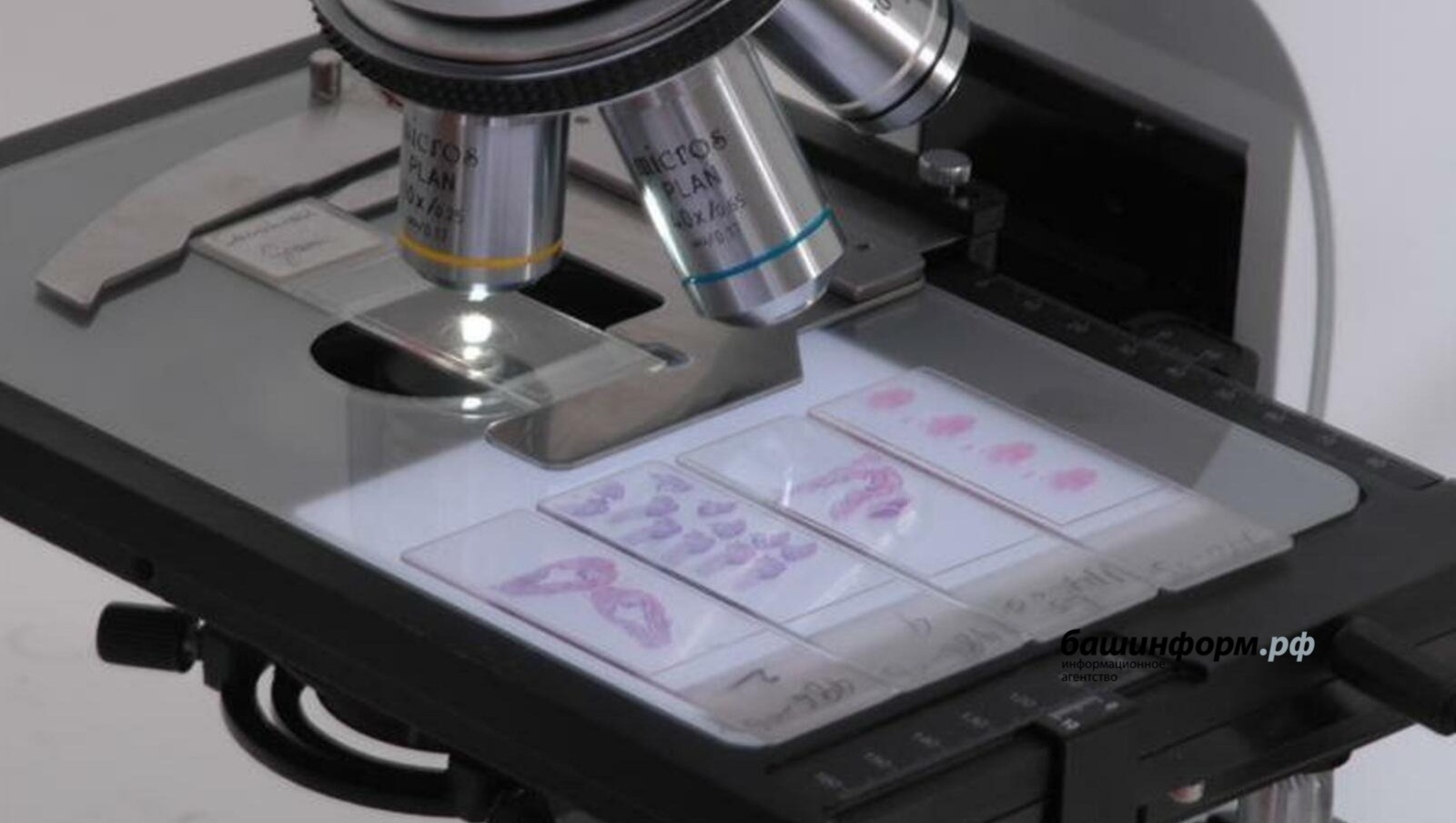 Рәсәйҙә вируслы гепатит менән ауырыусылар исемлеге төҙөлә