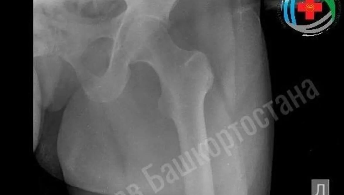 Жительницу Уфы спасли от перелома бедра из-за больной почки